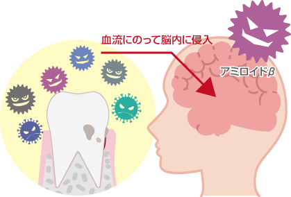 認知症に関する脳と歯周病の図