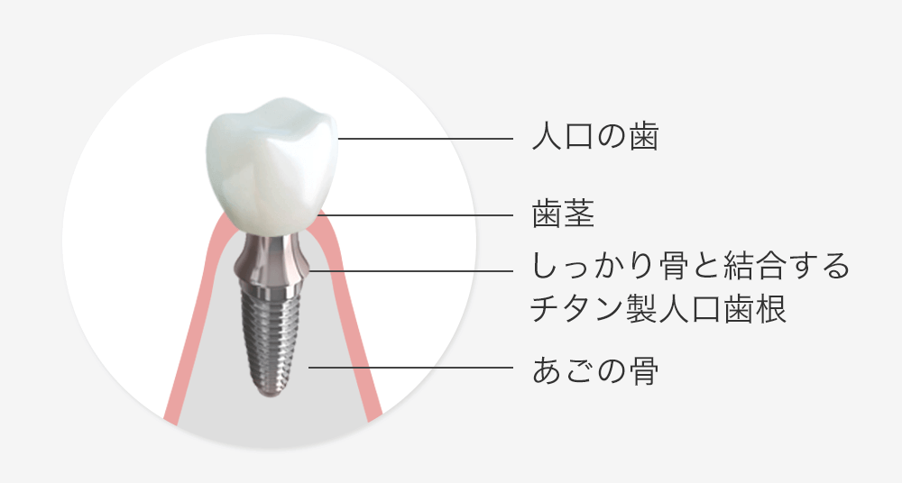 インプラント