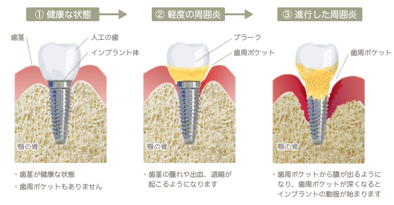 インプラント周囲炎