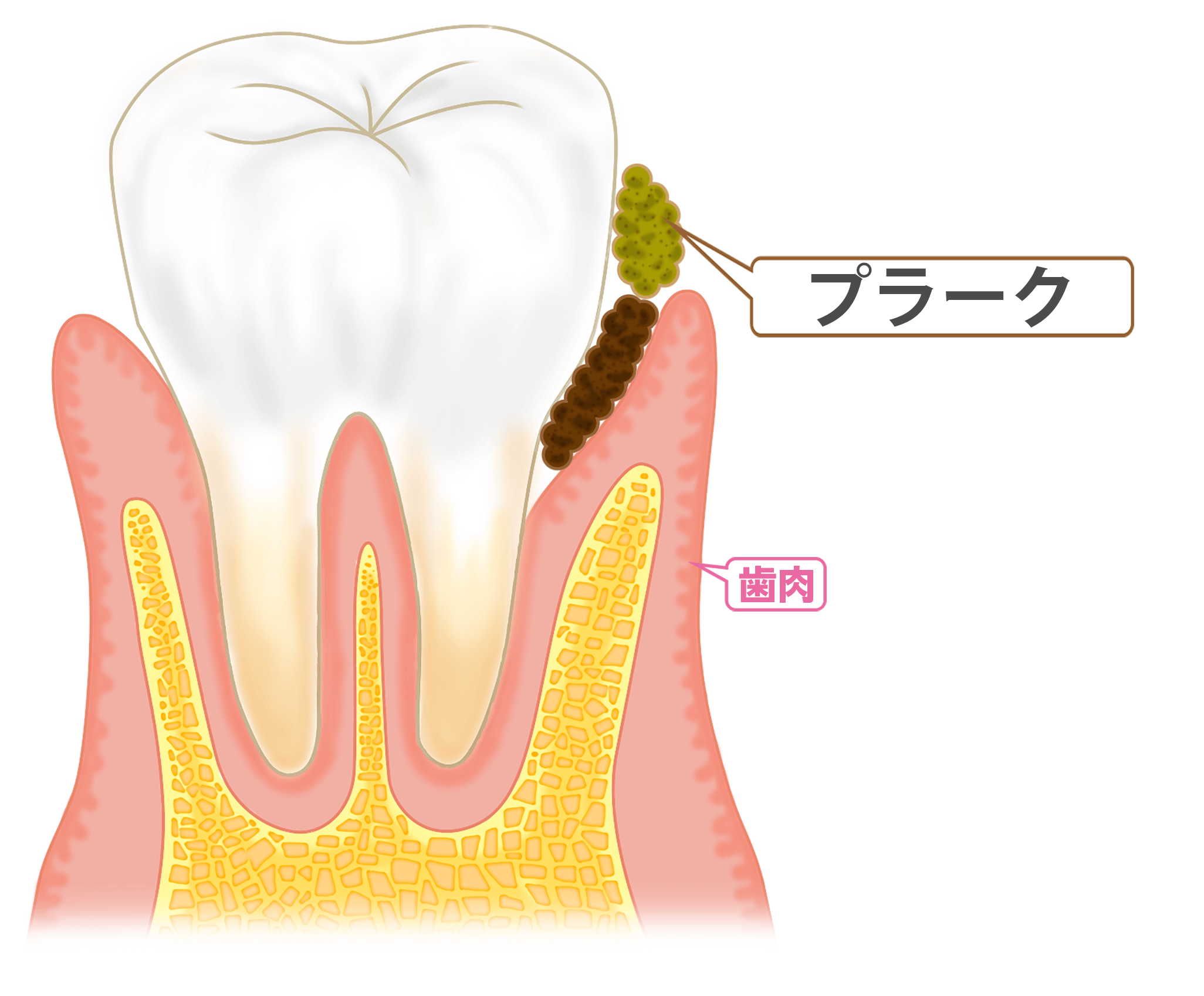 プラーク・細菌の図