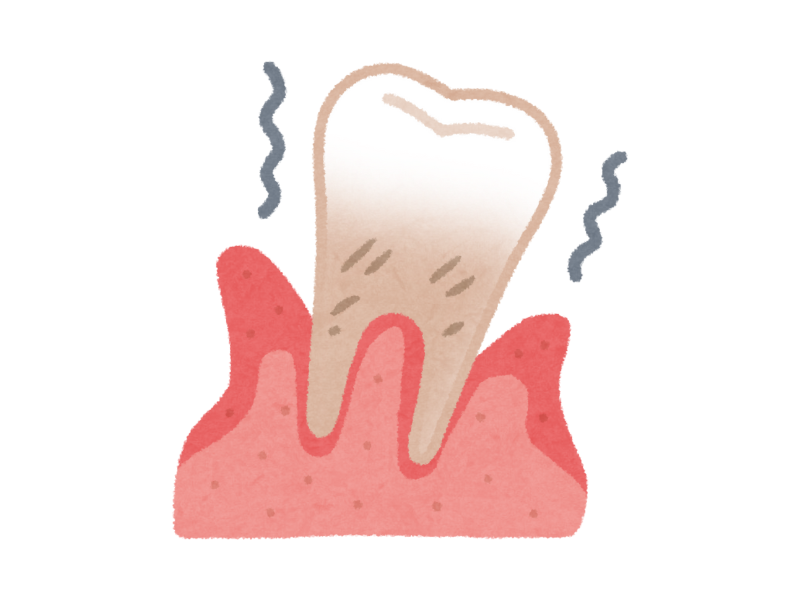 歯肉炎・歯周病による出血