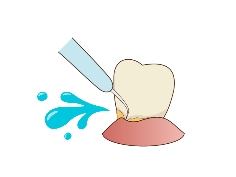 超音波スケーラー