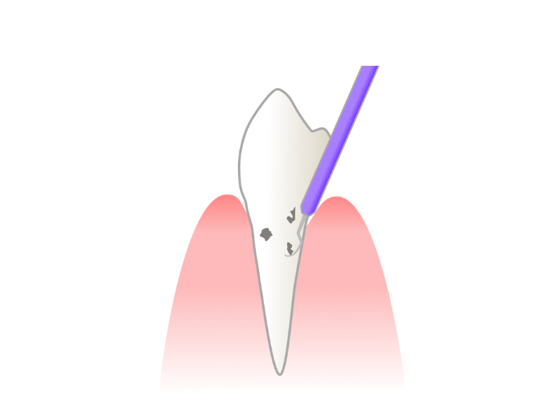 SRP（スケーリング・ルートプレーニング）