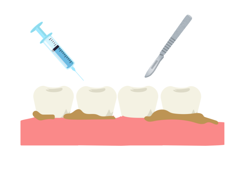 歯周外科処置