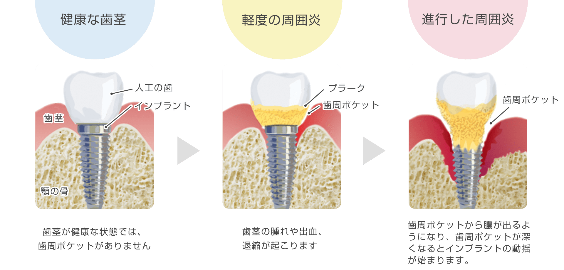 インプラント周囲炎　歯医者　桜新町