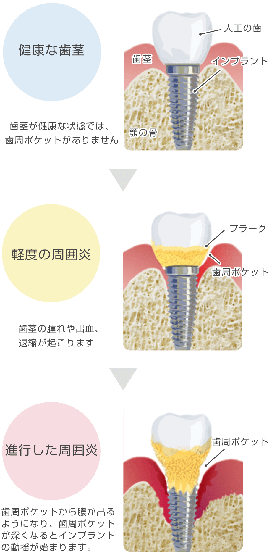 インプラント周囲炎の原因 治療 長持ちさせるポイント 志木の歯医者 ファミリー歯科医院