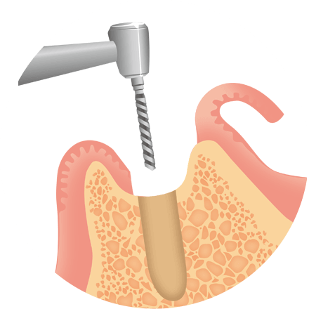 インプラント治療の流れ　1次手術