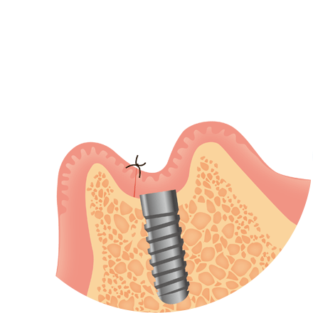 インプラント治療の流れ　1次手術