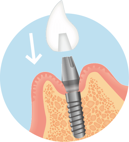インプラント治療の流れ　2次手術