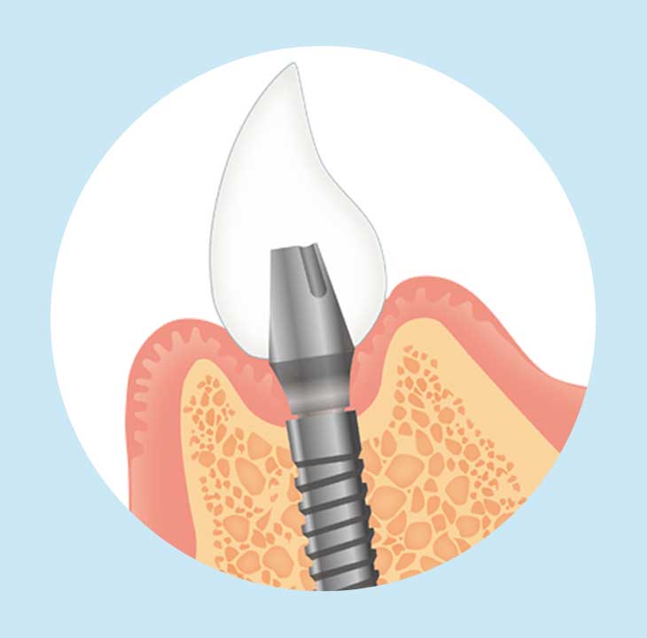 インプラント治療の流れ　最終補綴物の装着