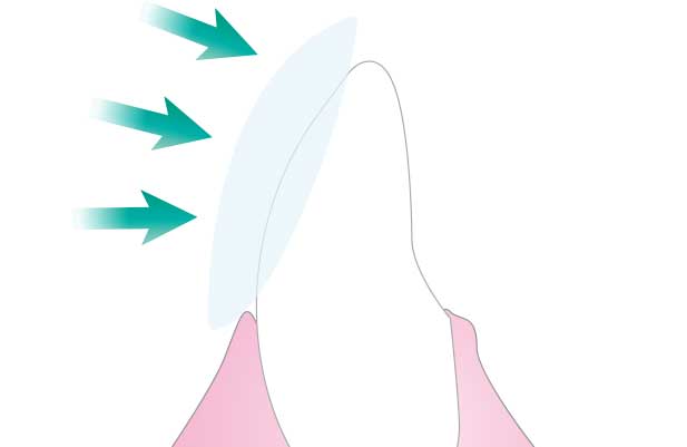 ラミネートベニア